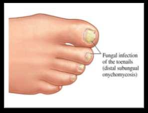 Figure 1: Fungal infection of toenails Figure 2: Different parts of nail II OBJECTIVE: In the present work, we are