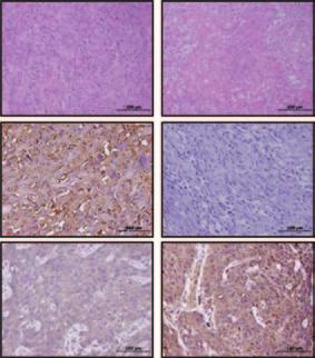(d f) Comined tretment silences signling, triggers poptosis, nd suppresses xenogrft tumor growth.