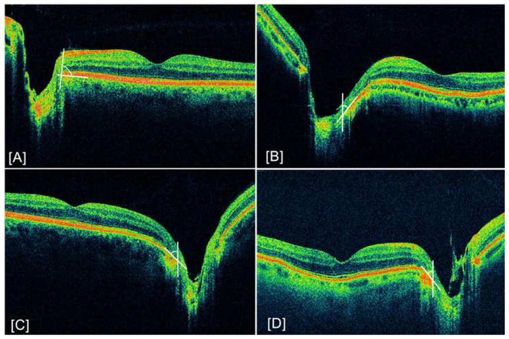 Manjunath et al. Page 12 Figure 4. Example of abnormal retinal sloping White lines delineate the angle between the optic disc edge and retinal pigment epithelium (RPE) cell layer.