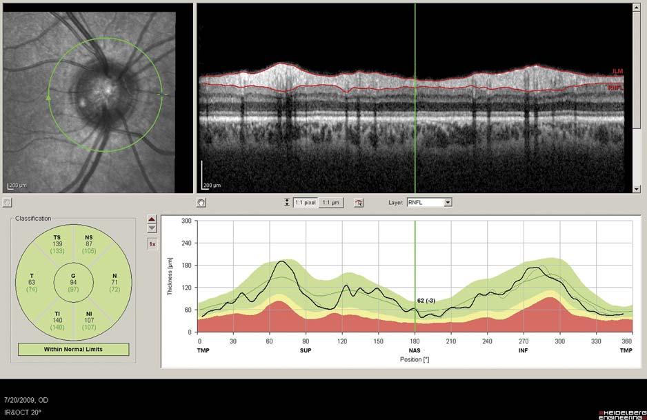 J Glaucoma Volume 00, Number 00, 2010 Reproducibility of RNFL Measurements by SD-OCT FIGURE 1.