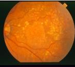 Fundus photography and its segmentation, (a) original color fundus photography, (b) segmented vessels C.