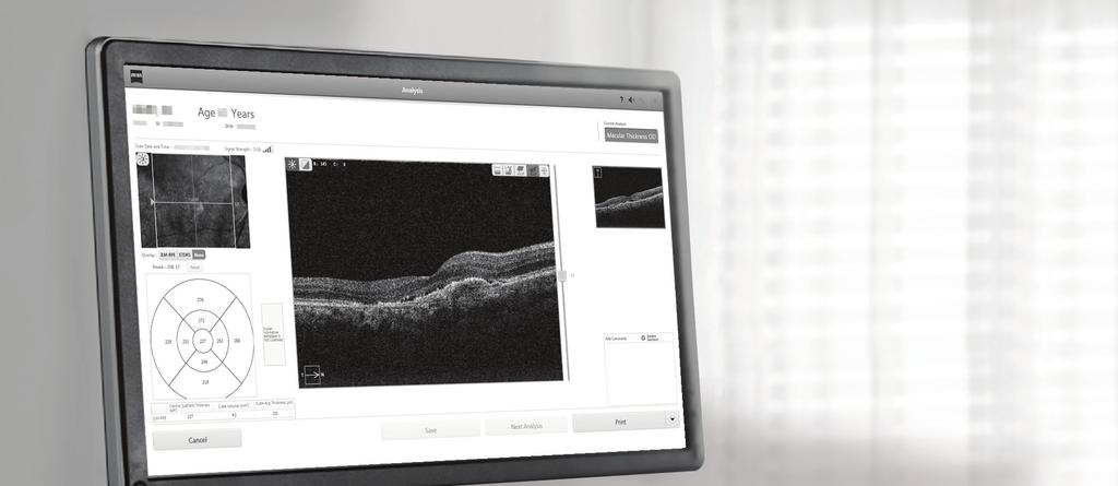 Clearer images for deeper insight ZEISS PRIMUS 200 inherits the fundamental quality of world-class ZEISS optics, providing you with clear and compelling OCT and fundus images to help you detect