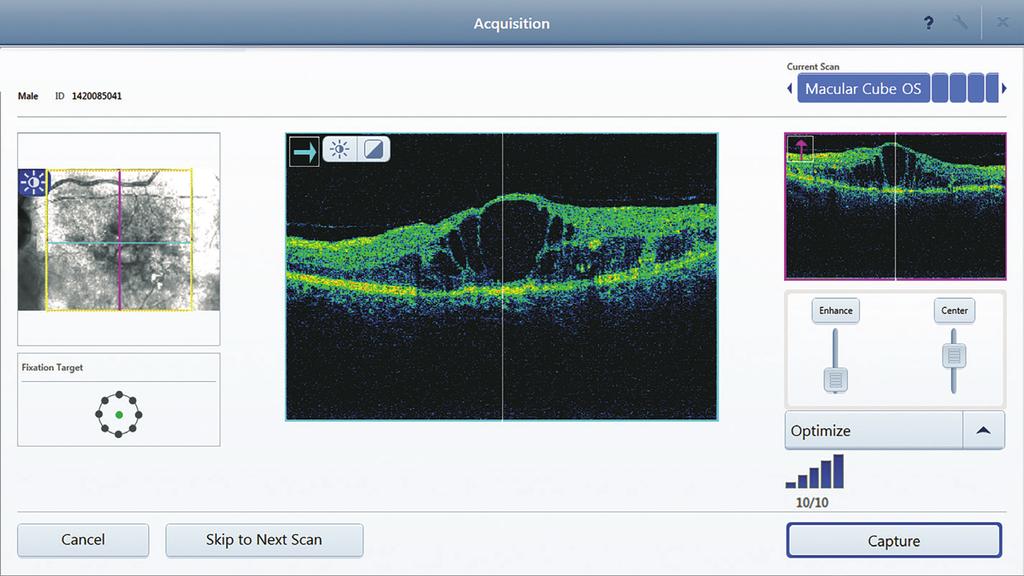 Simplicity through smart workflow ZEISS PRIMUS 200 utilizes a simple 3-step process for capturing all anterior and posterior segment scans.