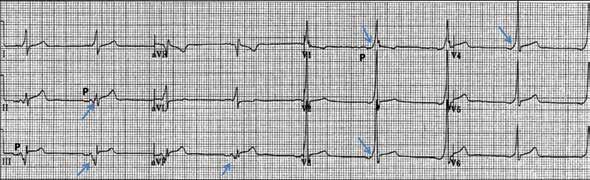 ST-SEGMENT ELEVATION STEMI or preexcitation? FIGURE 10. At first glance, it seems there is ST-segment elevation in the inferior leads II, III, and avf, with a wide Q wave.