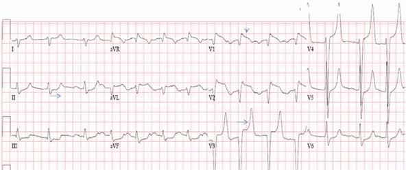 On further analysis, however, a slur is seen on the upslope of QRS in leads V 1 to V 6 (arrows), and the P wave is riding this slur.