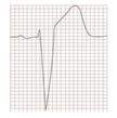 ST-SEGMENT ELEVATION Patterns of ST-segment elevation ST-segment elevation myocardial infarction (STEMI) FIGURE 1 ST convex upward with wide T wave and ST-T blending into one dome Early