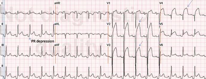 ST-SEGMENT ELEVATION STEMI or pericarditis? FIGURE 2. Diffuse ST-segment elevation with ST-segment depression in lead avr. This initially suggests pericarditis.