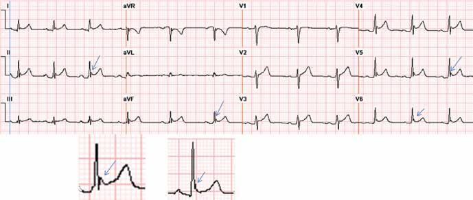 ST-SEGMENT ELEVATION Early repolarization FIGURE 4. Early repolarization with ST-segment elevation is seen in the inferior leads and in the anterolateral leads V 2 to V 6.