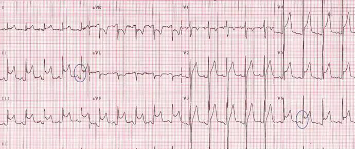 ST-SEGMENT ELEVATION Pericarditis FIGURE 6. Diffuse ST-segment elevation in most leads, with ST depression in lead avr and an isoelectric ST segment in V 1.