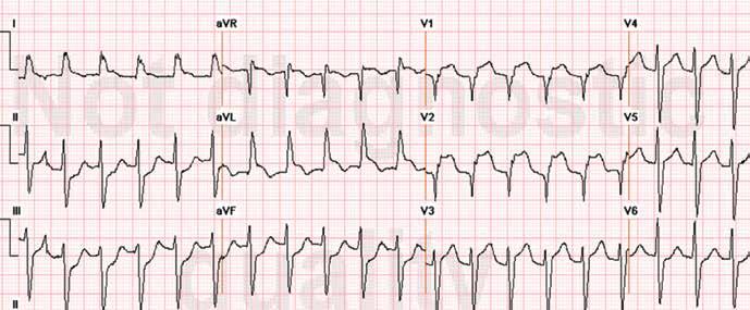 complex); and no Q wave is seen. Furthermore, ST elevation does not exceed 5 mm; ST and T heights are smaller than QRS height; and PR depression is present (circled areas).