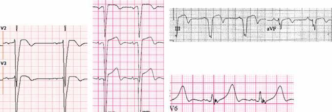HANNA AND GLANCY Left bundle branch block and STEMI FIGURE 8. Left bundle branch block with discordant ST-segment changes.