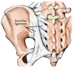 3. SIJ dysfunction and no glutes Pain: PSIS, weightbearing, usually one sided
