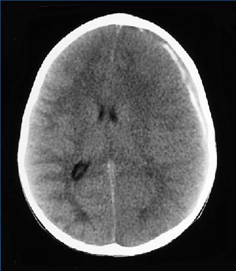 Rule: CT or 6 hour obs for all < 2 years with non-frontal scalp hematoma Location, location : Temporal >
