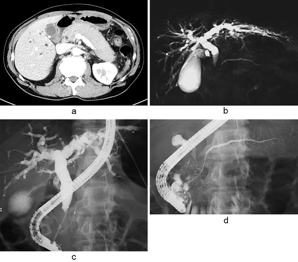 Figure 1. Images obtained before treatment. (a) Computed tomography (CT) shows a bulky pancreas with a capsule-like rim without dilation of the pancreatic duct.