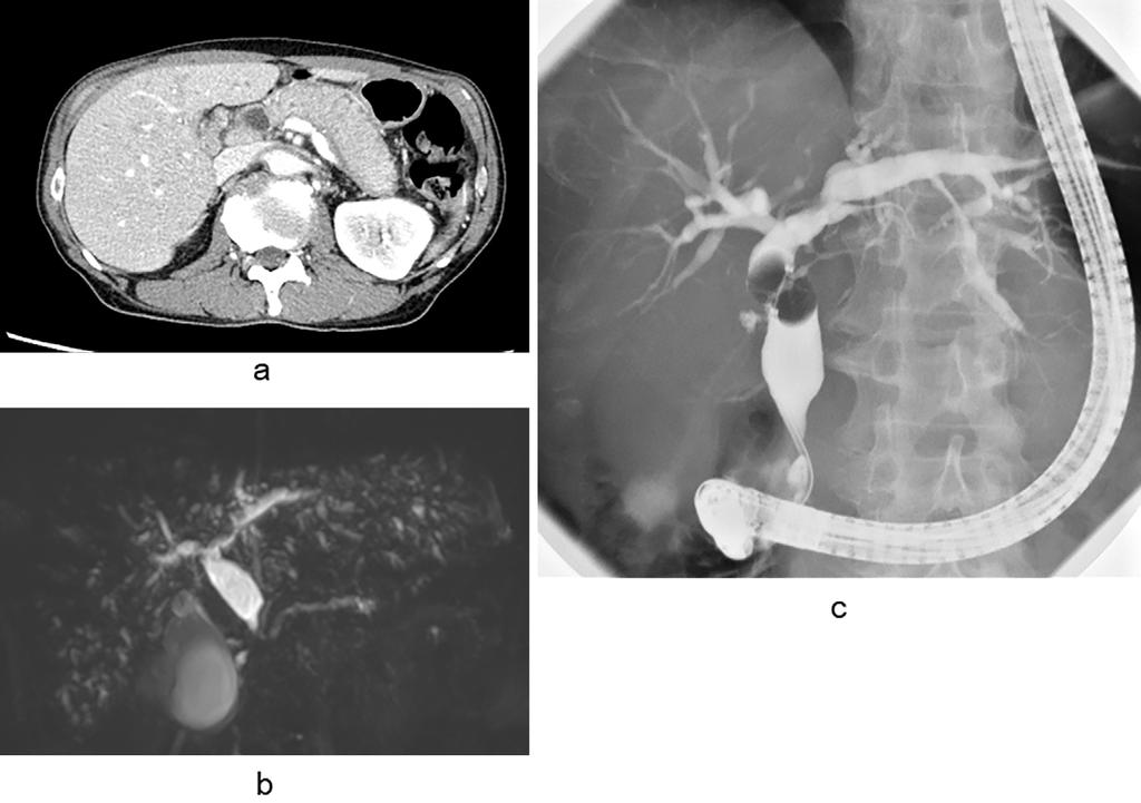 Figure 3. Images obtained at 8 months after tapering prednisolone treatment. (a) CT shows a bulky pancreas with a capsule-like rim without dilation of the pancreatic duct, as seen previously.