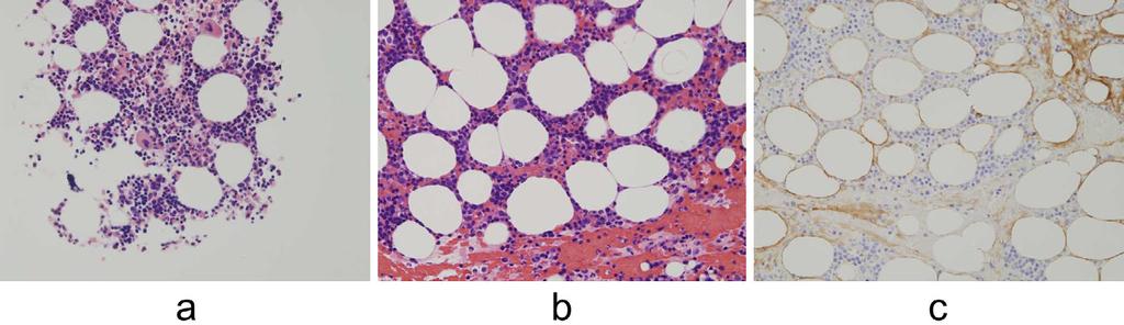 Figure 4. Pathological images of a bone marrow specimen obtained by bone marrow aspiration. (a, b) Hematoxylin and Eosin staining shows erythroid hyperplasia (M/E ratio, 1.