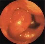 Diagnosis; TVUS show very thick endometrium /Saline
