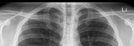 Chest X-ray in IPF Non-specific