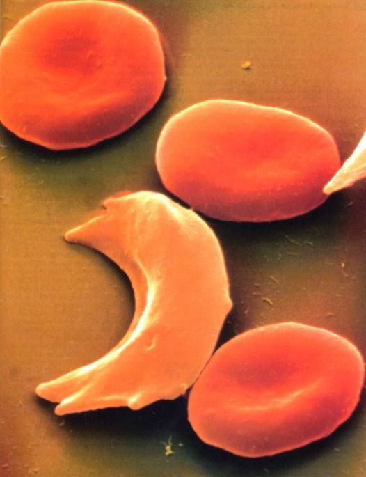 Sickle Cell Disease (SCD) Pulmonary complications are a major cause of morbidity and premature death SCD is the most common