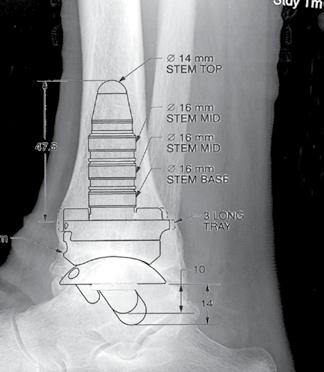 Additionally, the ability to fit greater than 4 stem pieces in the tibia without cortical wall disruption is limited.