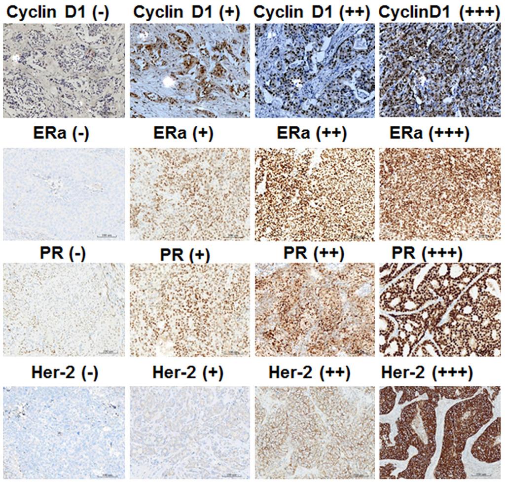 Figure 1. Expression of cyclin D1, estrogen receptor (ER), progesterone receptor (PR), and human epidermal growth factor receptor-2 (Her-2) in breast cancer tissues.