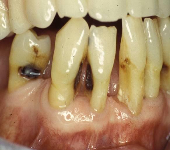 Root Caries 10 Causes In patients with gingival recession tooth roots become progressively more exposed Roots are