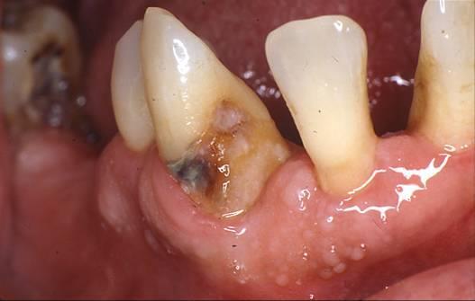 and progress rapidly Treatment Lesions can be prevented or arrested using fluoride containing toothpaste, gels, or