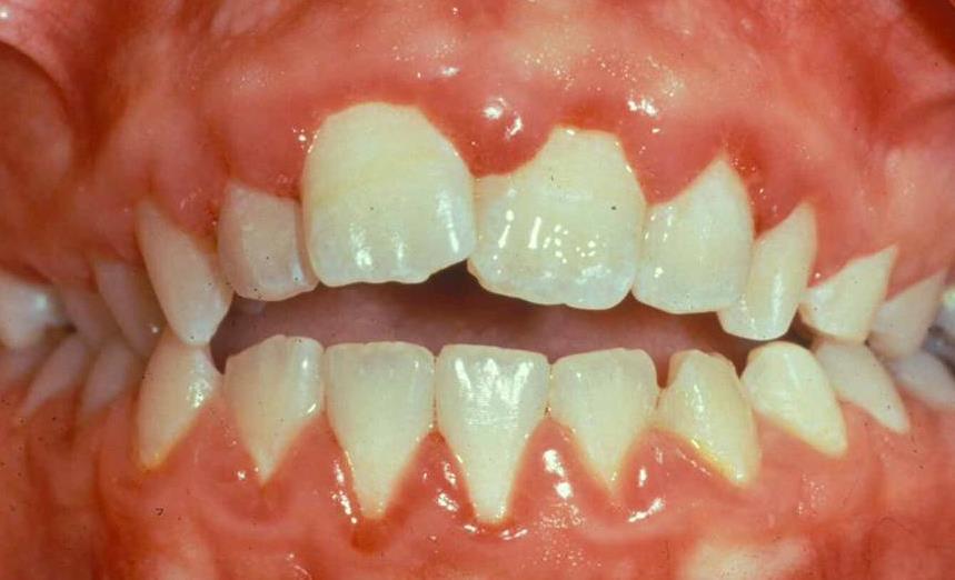 Gingivitis 11 Symptoms Tenderness Erythema Bleeding gums Mild gum swelling Bad
