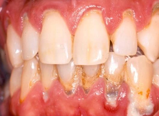Periodontitis 12 Causes Chronic plaque exposure causes inflammation which leads to Destruction of periodontal