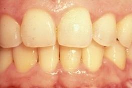 Tooth Changes with