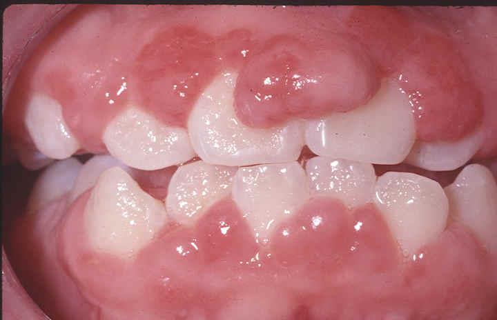 Gingival Hyperplasia 16 Symptoms Unsightly gingival enlargement Teeth become hard to