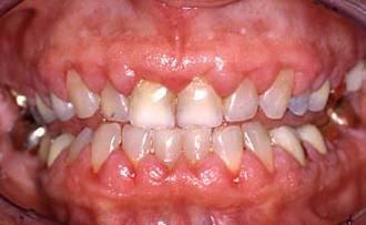 systemic disease Treatment Meticulous hygiene Regular cleanings May require gum