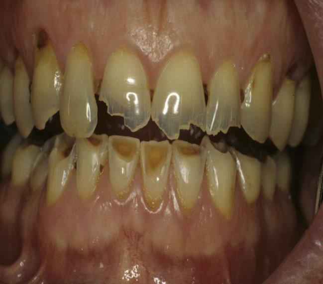 Dental Erosions 17 Symptoms Teeth become smooth and glassy Pulp exposure