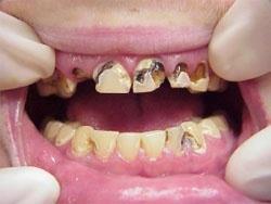 Meth Mouth 20 Symptoms Typical users:18- to 40-year old white males in rural, western regions Rampant caries,