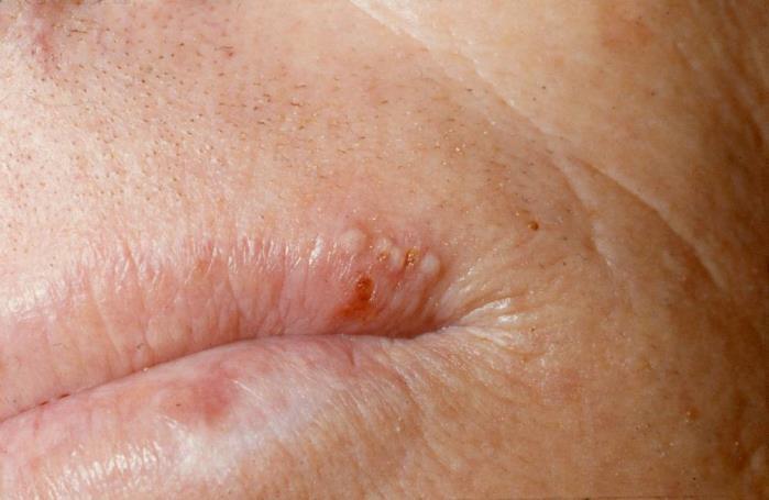 Herpes Labialis 22 Symptoms Burning, itching, or pain 12 36 hours before