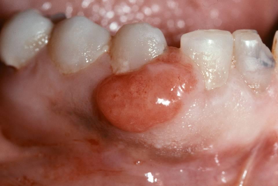 Pyogenic Granuloma (skin growth) Symptoms Red, nonpainful, smooth, or lobulated mass Often bleeds when touched Usually develops on gingiva May be a few millimeters to several centimeters in diameter