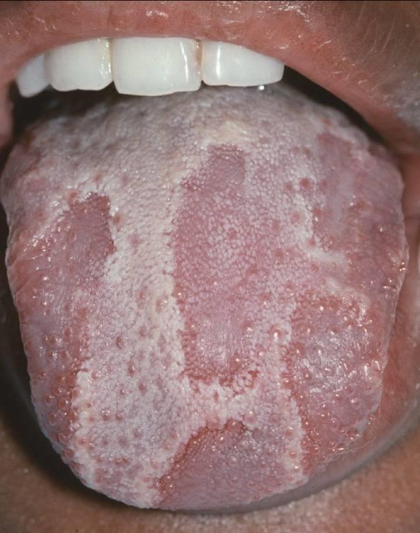 Geographic Tongue 25 Symptoms May produce pain or burning, especially with spicy