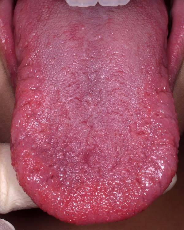 Fissured Tongue 27 Symptoms Usually asymptomatic Number, depth, and direction of fissures varies considerably Food debris may lodge between the fissures leading to bad breath and rarely irritation