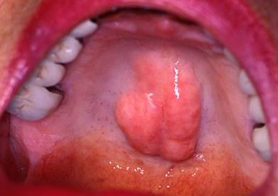 Bony Tori 28 Symptoms Non-cancerous bony bulge in mouth Develop in adulthood Present in