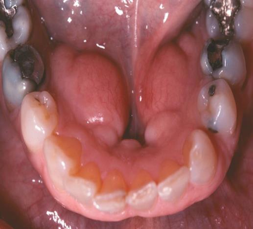 function Interferes with denture fabrication Is subject to recurrent trauma or surface