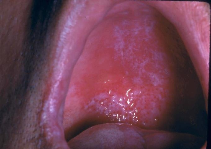 Candidiasis 29 Causes Overgrowth of yeast in the mouth Immunosupressed states Poorly fitting and