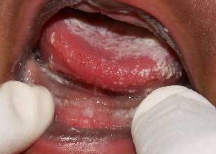 thrush Most common form May present with burning sensation Treatment Administer topical or antifungal