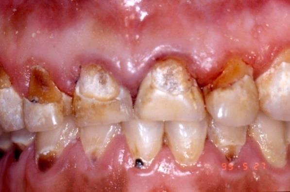Adult Caries 9 Additional Risk Factors Physical disabilities Make brushing and other oral hygiene activities more difficult Existing restoration or appliances Can trap food Most likely site of caries