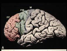 Clustering of neurobehavioural Factor 2 Tiredness Low mood Sleep problems Clustering of neurobehavioural Factor 3 Irritability Impatience Mood swings Verbal outbursts Pattern of neurobehavioral