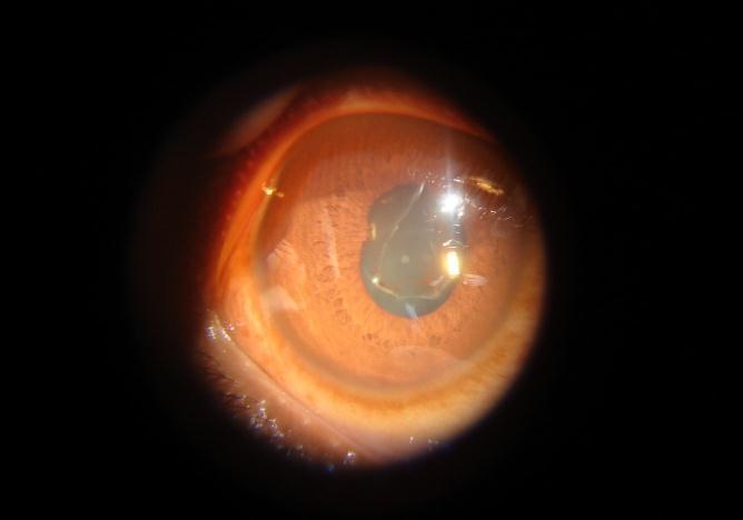 Fig 3. Persistent posterior synechiae Fig 4. Phacolytic uveitis. IV. Discussion The present study was conducted in the Department of Ophthalmology, Adichunchanagiri Institute of Medical Sciences, B.G.