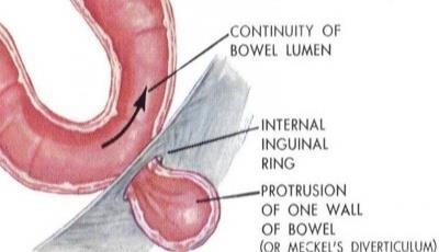 Clinical types of hernia Richter s hernia (intestinal wall hernia) a hernia that has