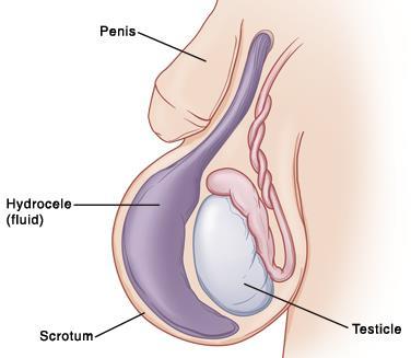 peritoneal cavity via processus vaginalis.