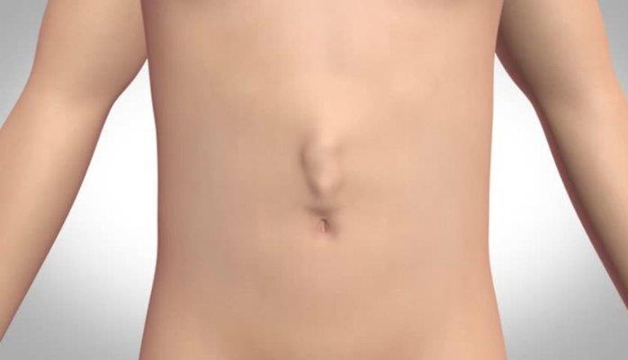 Epigastric hernia Incidence 1-5% Men > women Pre-peritoneal fat protrusion through