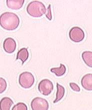 TMA Initial Diagnosis Microangiopathic hemolytic anemia(hb < 12 g/dl)