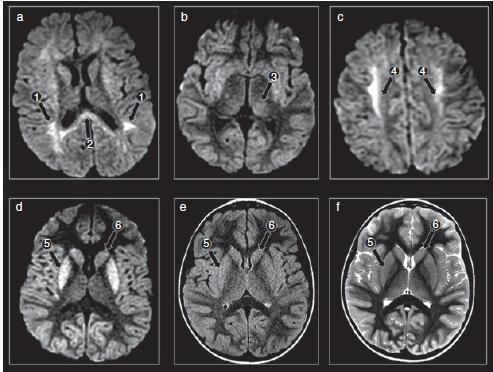 Neurologic involvement in ahus (TMA) Gitiaux
